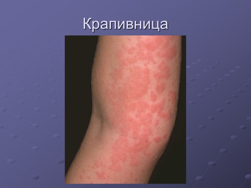 Крапивница